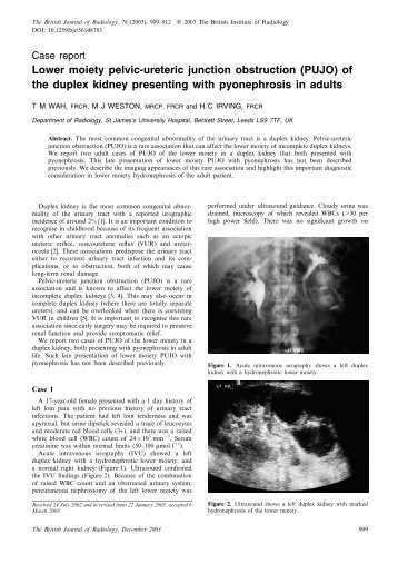 Lower moiety pelvic-ureteric junction obstruction (PUJO) of the ...