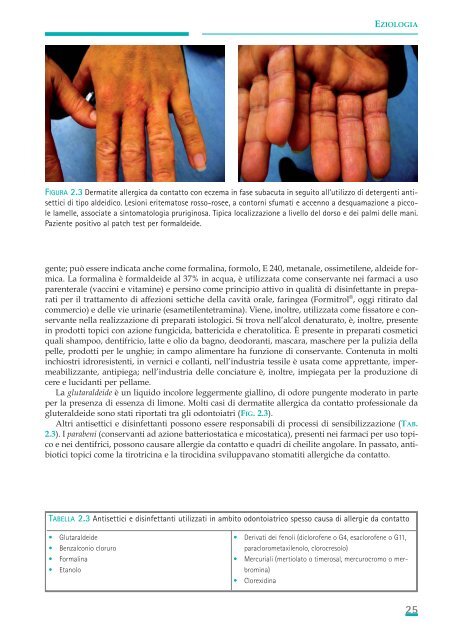 Allergie e reazioni avverse in Odontostomatologia - Associazione ...