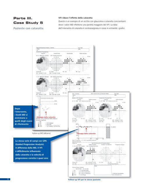 HFA II-i Con Guided Progression Analysis (GPA