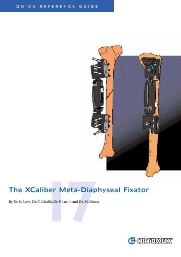 The XCaliber Meta-Diaphyseal Fixator - Orthofix.com