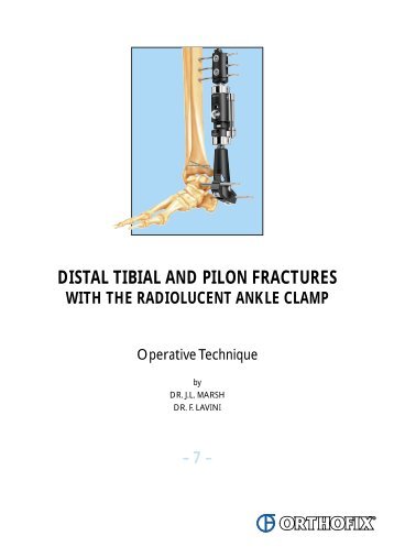 DISTAL TIBIAL AND PILON FRACTURES - Orthofix International