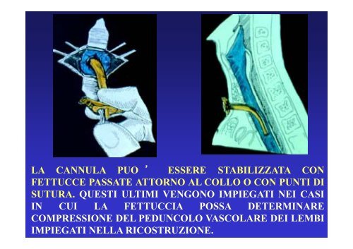 Emergenze in chirurgia maxillo facciale - Supramicrosurgery