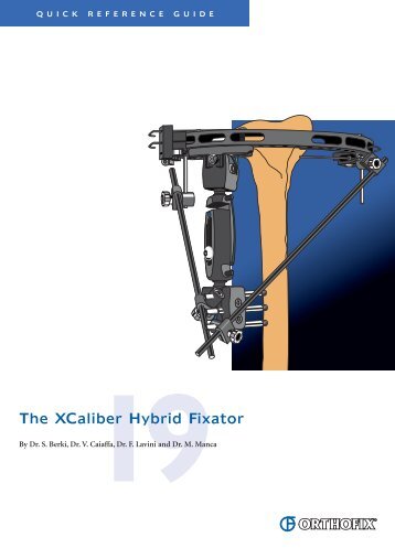 The XCaliber Hybrid Fixator - Orthofix.com