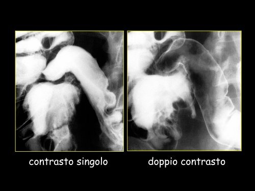 Ecografia: assenza di ispessimento parietale patologico - Tsrm Foggia