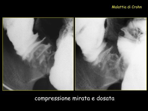 Ecografia: assenza di ispessimento parietale patologico - Tsrm Foggia