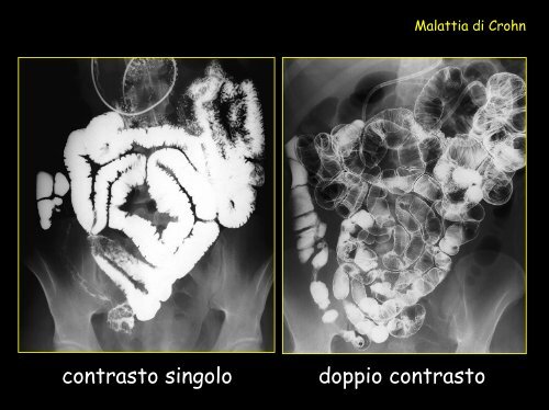 Ecografia: assenza di ispessimento parietale patologico - Tsrm Foggia