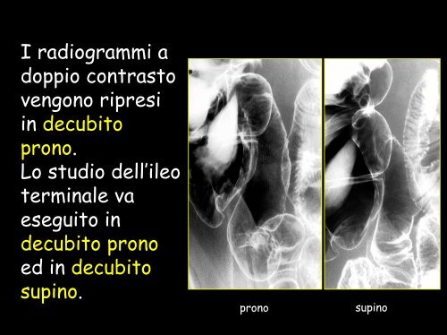 Ecografia: assenza di ispessimento parietale patologico - Tsrm Foggia