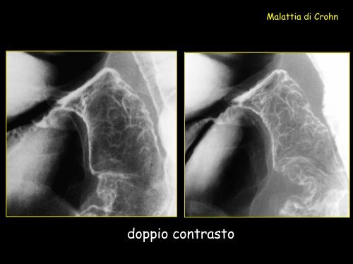 Ecografia: assenza di ispessimento parietale patologico - Tsrm Foggia