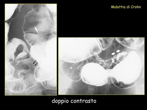 Ecografia: assenza di ispessimento parietale patologico - Tsrm Foggia