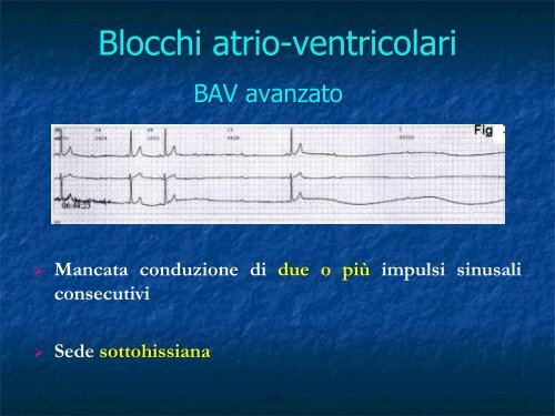 Advanced Cardiac Life Support Parte III: Le Emergenze Bradiaritmiche