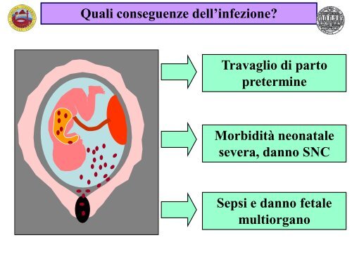 Possibili eziologie del parto pretermine spontaneo - Associazione ...