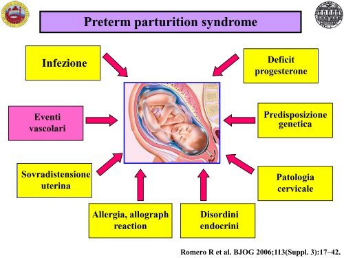 Possibili eziologie del parto pretermine spontaneo - Associazione ...