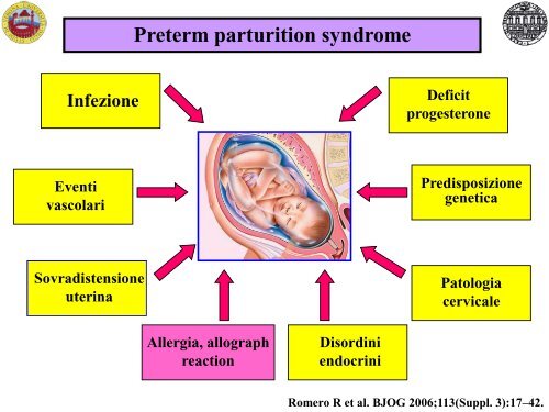 Possibili eziologie del parto pretermine spontaneo - Associazione ...