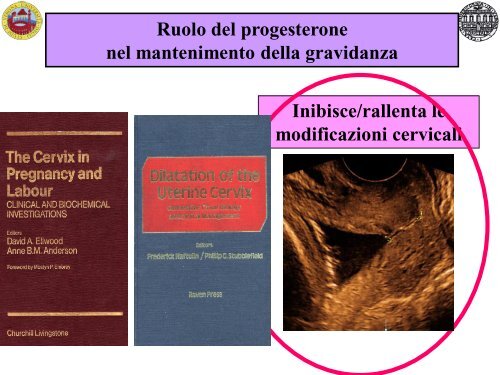 Possibili eziologie del parto pretermine spontaneo - Associazione ...