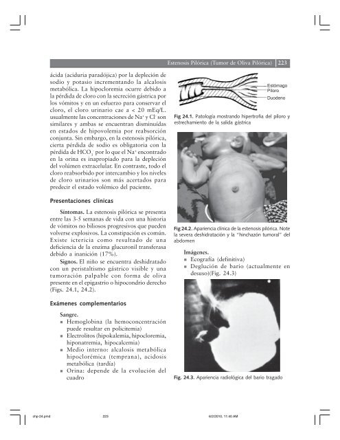 Capítulo Estenosis Pilórica (Tumor de Oliva Pilórica) - Clasa Anestesia