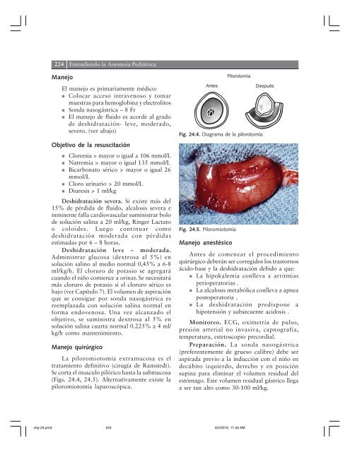 Capítulo Estenosis Pilórica (Tumor de Oliva Pilórica) - Clasa Anestesia