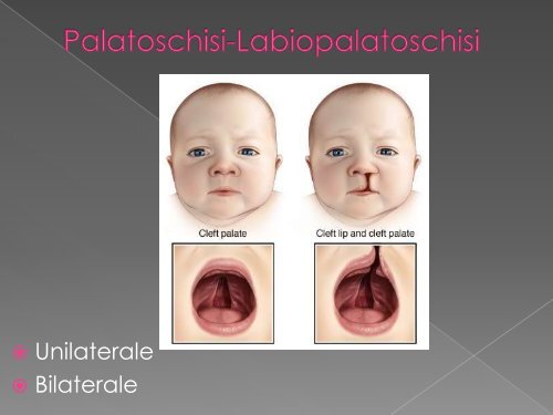 Scarica l'intervento [PDF 1.96MB] - Labiopalatoschisi