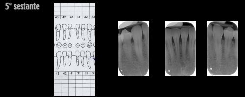 Presentazione di un caso clinico per il piano di ... - Dentalbrera