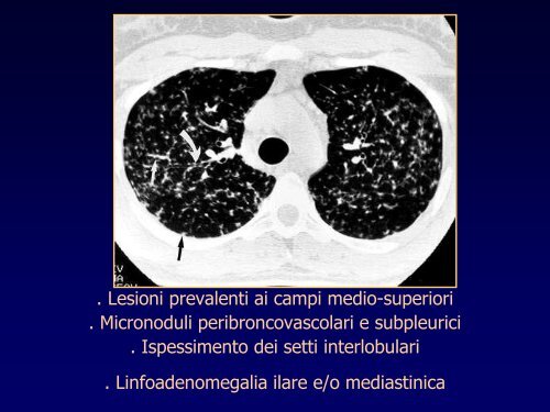 INTERSTIZIOPATIE POLMONARI - laprimapietra - Altervista