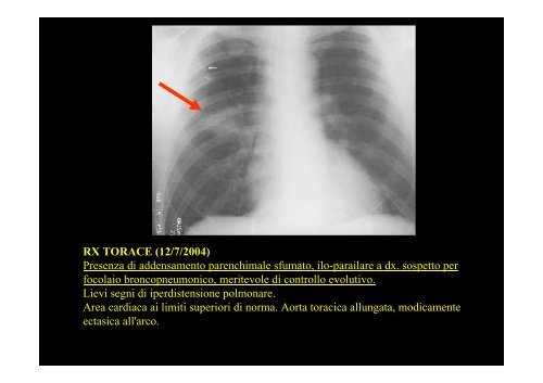 3 tosse ed emottisi - Facoltà di Medicina e Chirurgia - Università ...