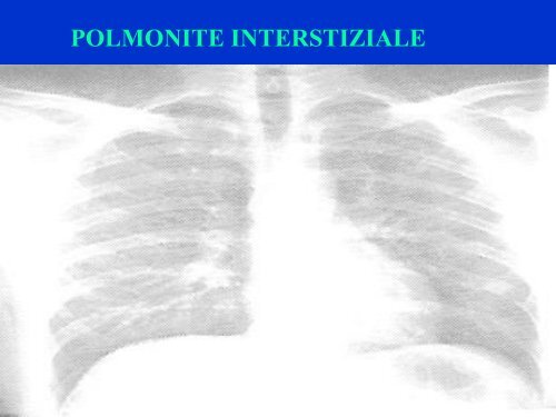 Polmoniti infettive - Medicina e Chirurgia - Università degli Studi di ...