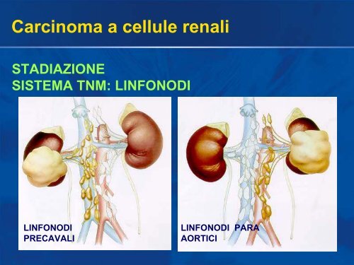 Carcinoma a cellule renali - Uroandrologiapuglia