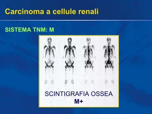 Carcinoma a cellule renali - Uroandrologiapuglia