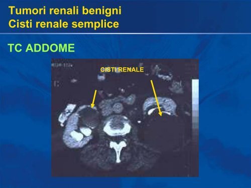 Carcinoma a cellule renali - Uroandrologiapuglia