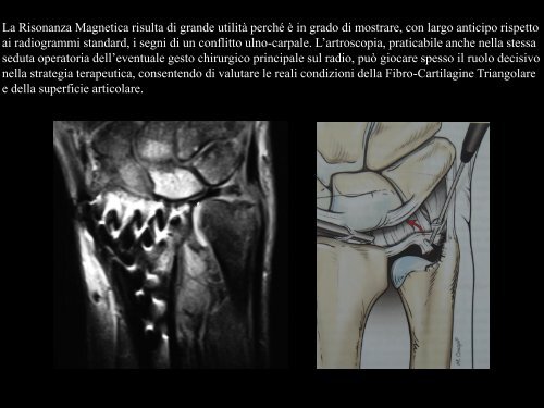 Frattura di Polso - Chirurgia della mano