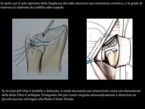 Frattura di Polso - Chirurgia della mano