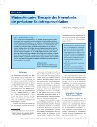 Minimal-invasive Therapie des Nierenkrebs: die perkutane ...