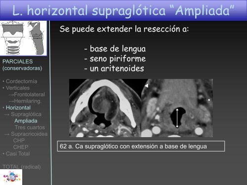 TOMOGRAFÍA COMPUTARIZADA en FIBROSIS QUÍSTICA