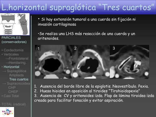 TOMOGRAFÍA COMPUTARIZADA en FIBROSIS QUÍSTICA