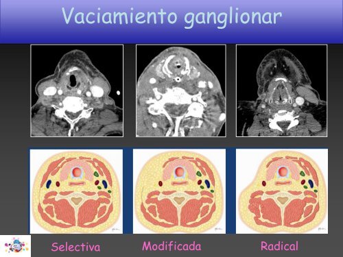 TOMOGRAFÍA COMPUTARIZADA en FIBROSIS QUÍSTICA