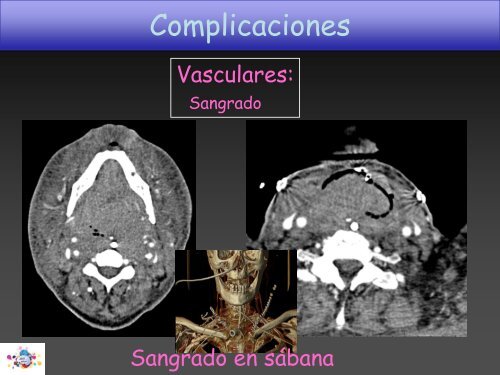 TOMOGRAFÍA COMPUTARIZADA en FIBROSIS QUÍSTICA