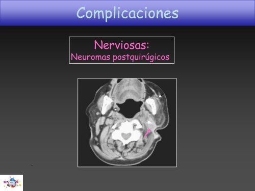 TOMOGRAFÍA COMPUTARIZADA en FIBROSIS QUÍSTICA