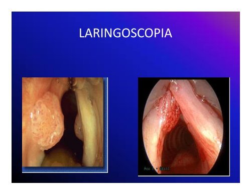 papilomatosis respiratoria recurrente - Medicos de El Salvador