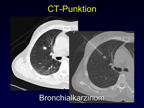 Radiologische Diagnostik und Therapie von Tumorerkrankungen