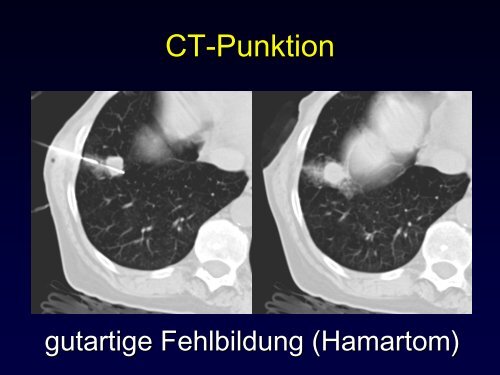 Radiologische Diagnostik und Therapie von Tumorerkrankungen