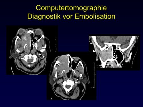 Radiologische Diagnostik und Therapie von Tumorerkrankungen