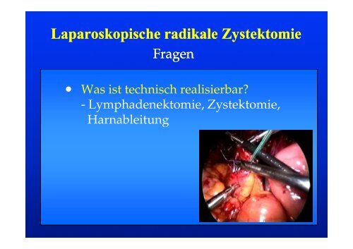 Laparoskopische radikale Zystektomie