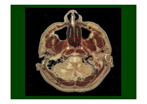 Tumori maligni della sfera ORL - Facoltà di Medicina e Chirurgia