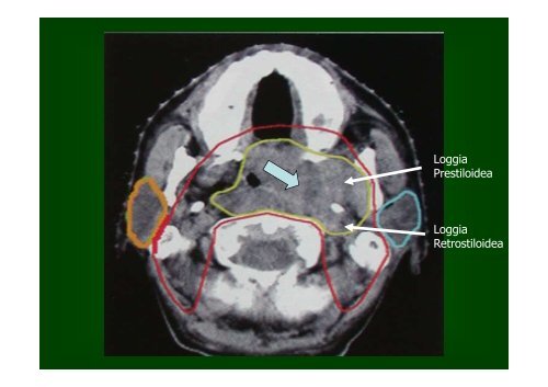 Tumori maligni della sfera ORL - Facoltà di Medicina e Chirurgia