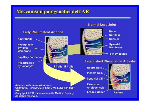 Artrite Reumatoide - ASL n. 4 Chiavarese