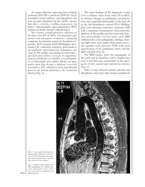 Associação de Arco Aórtico Cervical.pdf