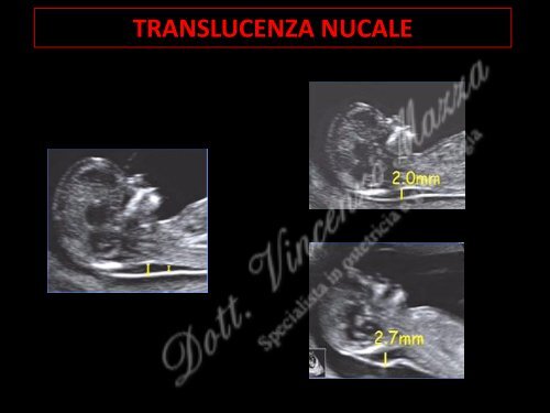 Presentazione sul test combinato.pdf - Dottorvincenzomazza.it