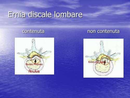 La patologia discoartrosica - Facoltà di Medicina e Chirurgia