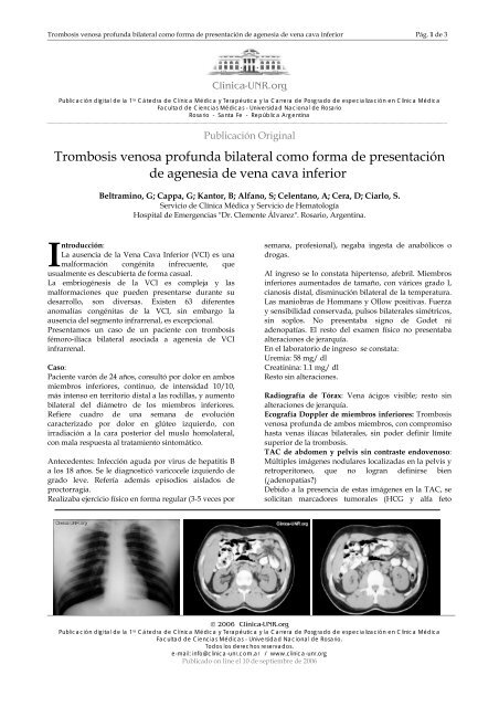 agenesia+vena+cava+de