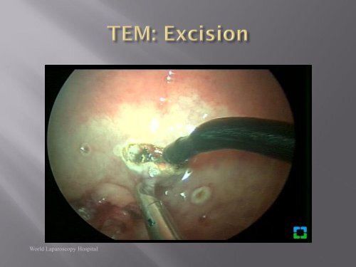 Transanal Endoscopic Microsurgery The file size in 5 to 15mb will ...