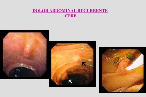 Dolor Abdominal Recurrente Dr. Cueto Rua.pdf - codajic